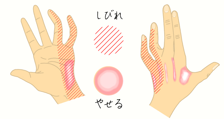 肘部管症候群 イメージ