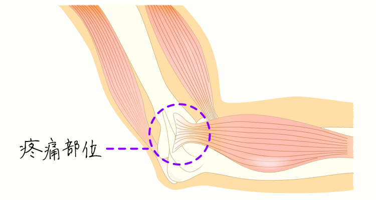 上腕骨外側上顆炎（テニス肘） イメージ